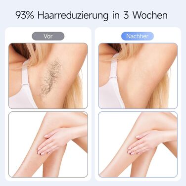 Пристрій для епіляції IPL MLAY: Швидка та безболісна епіляція лазером для обличчя, тіла та зони бікіні (для чоловіків та жінок)