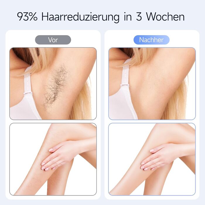 Пристрій для епіляції IPL MLAY: Швидка та безболісна епіляція лазером для обличчя, тіла та зони бікіні (для чоловіків та жінок)