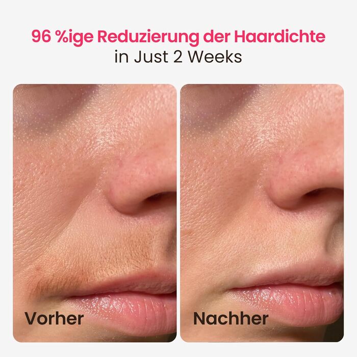 Пристрій для епіляції IPL, 25 Дж, лазерне видалення волосся для жінок та чоловіків, безболісна технологія охолодження сапфіром, довготривалий ефект для зони бікіні, ніг, пахв, тіла, колір: шампань-золото